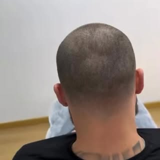 Saç pigmentasyonu ile daha dolgun ve doğal bir görünüm. Sonucu videoda görebilirsiniz.
* Öncesi ve s