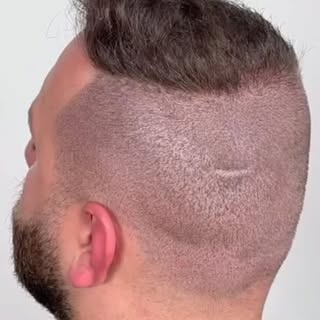 Saç ekimi yaptırdınız ama arkada kalan o donör bölge izleri canınızı mı sıkıyor? 🤫 Çoğu kişi saç ek