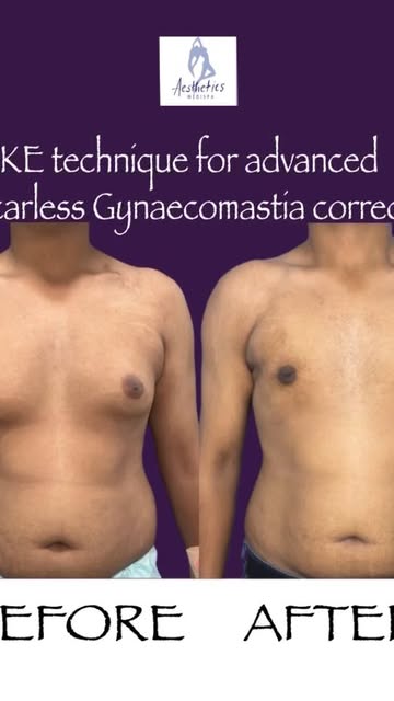 BEFORE → AFTER | VASER™ TECHNIQUE

From unwanted chest fullness to a more defined, masculine contour