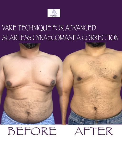 BEFORE → AFTER | VASER™ TECHNIQUE
From excess chest fullness to a flatter, more defined chest. 💪✨
O