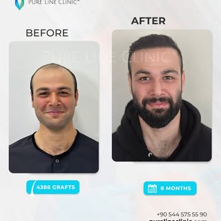 Real results.Get your hair back with Pure Line® ,here is our patient’s 8 months result.

Book your f