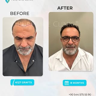 Real results.Get your hair back with Pure Line® ,here is our patient’s 10 months result.

Book your 