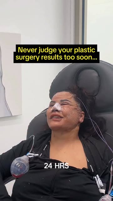 1 month post-op and you can already see her beautiful results 🙌🏾 What do you think?

The healing p