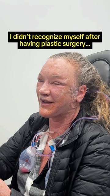 Years of sun damage GONE 💨 My beautiful patient is 61 years young and 1 month post-op! 

Do you thi