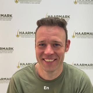 Erger jij je aan je inhammen of dunne plekken voor op je hoofd? Dan kun je haren verplaatsen van ach