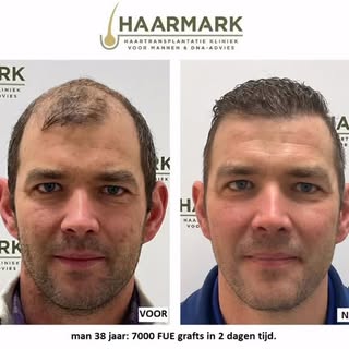 7000 fue grafts 1 jaar na behandeling in samenwerking met Omorfy

Disclaimer: Kijk uit! Jezelf mooie
