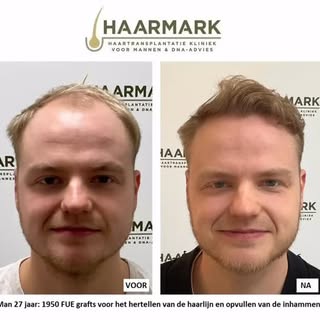 Met 1960 FUE hairgrafts kun je al een behoorlijk eind komen in je wens om inhammen op te vullen en j