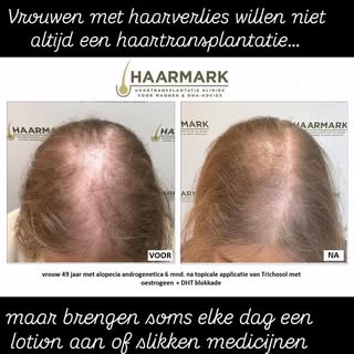 Als vrouw zit je niet te wachten op een haartransplantatie. Het is een kostbare ingreep en de downti