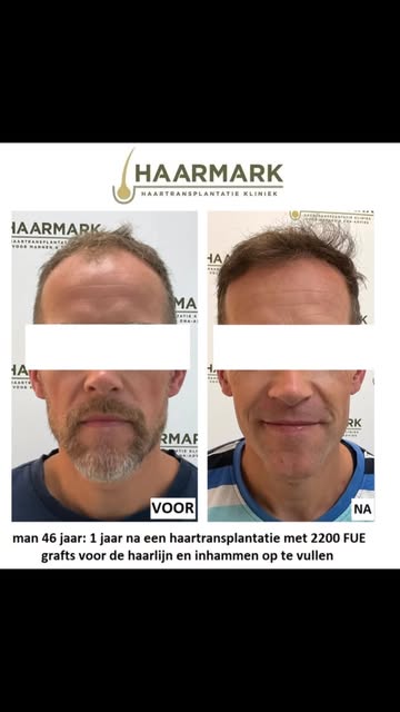 Met 2200 grafts kom je al een heel eind 🕺🏼