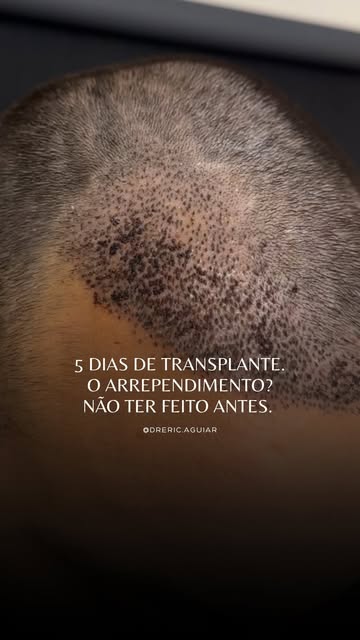 5 dias depois do transplante… e a transformação já começou. O resultado ainda vai evoluir muito, mas