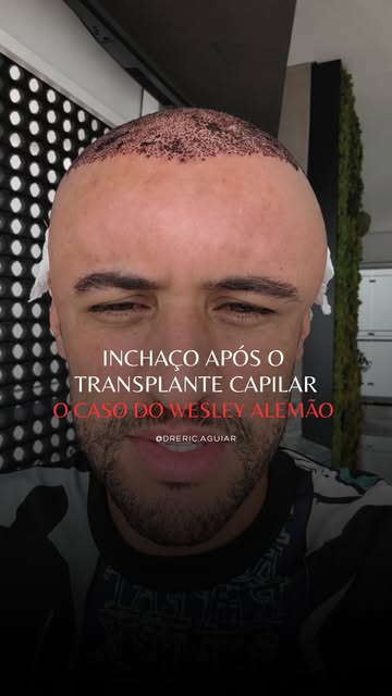 Inchaço no rosto após o transplante capilar é uma das dúvidas mais comuns. E aí vem a pergunta: prec
