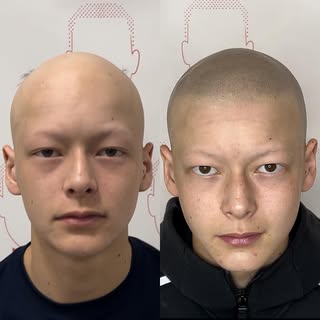 Ce jeune homme est venu à l’institut car il avait une pelade. Ce n’était pas la première fois pour l
