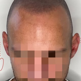 ➡️Pas de gros dégâts, mais un manque important au niveau de la ligne frontale et du vertex. Donc la 