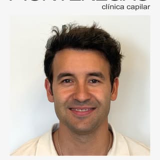 Paciente de 27 años; NW tipo III.

• Reconstrucción frontal con 3050 UFs, diseño natural y buscando 