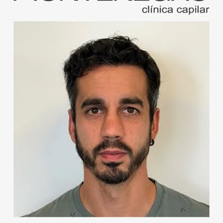 Paciente de 36 años; NW tipo IV.

• Reconstrucción completa del frontal extendido con 3335 UFs. Dise