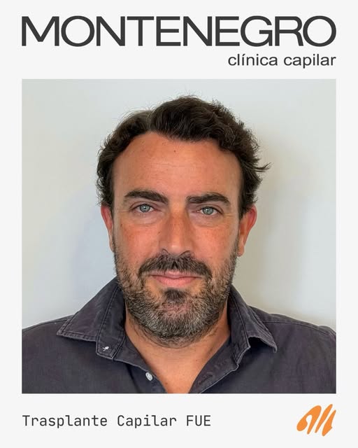 Paciente de 49 años; NW tipo V.

• Reconstrucción completa del frontal extendido hasta coronilla con