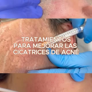 ¿Quieres mejorar tus cicatrices de acné? 

En @abdermaclinica somos super-especialistas en cicatrice