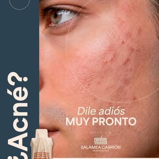 ¿Acné? 👀 Muy pronto tendremos una nueva forma de enfrentarlo.

Desde Brasil 🇧🇷 está por llegar a 
