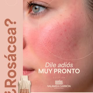 ¿Rosácea? 👀 Pronto tendremos algo nuevo que contarte.

Una nueva tecnología está por llegar a Cuenc