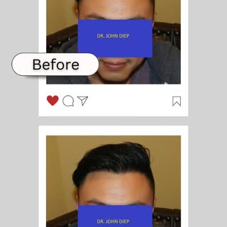 Transform your look with our expert hair transplant services ✨
Fuller, natural hair for a confident,
