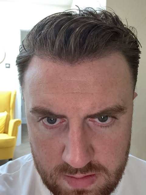 *4 month update from Irish Boxer @_thomascarty 

Everyone’s regrowth is different. Some patients hav