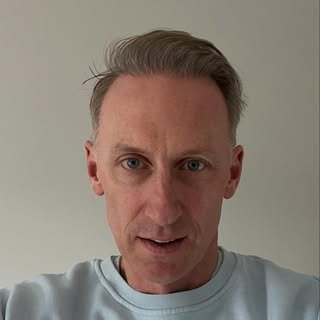 *5 month update

So I’m 5.5 months post hair transplant to restore my own hairline, and I can really