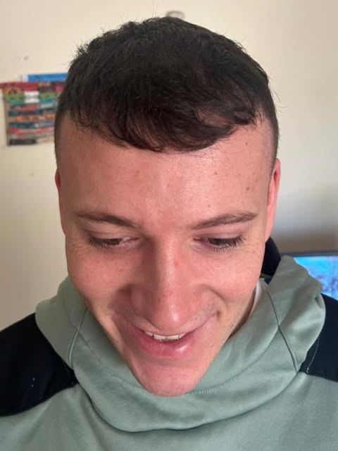 They say a picture captures 1000 words. I think this smile says it all. 2700 grafts for this patient