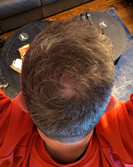 A lovely crown treatment for this patient. Great coverage and completely natural….1900 Grafts. 

#fu