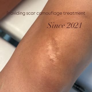 Years after an injury or surgery, a scar can still be the first thing you notice.

Scar camouflage h