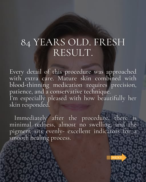 84 years old. Fresh lash line enhancement 🦋

Minimal redness, virtually no swelling, and just the r