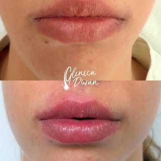 💋Un aumento de labios no se trata de sumar volumen por sumar, sino de encontrar el equilibrio perfe