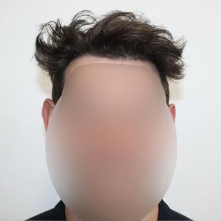 2700 grafts (5400+ hairs) later, swipe to see where we started…

Book a free consultation today with
