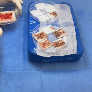Every graft counts… literally. Before a single graft is placed, every follicle is counted, checked, 