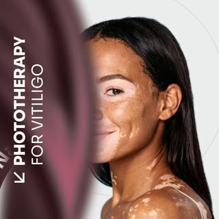 Support your vitiligo care journey with advanced Phototherapy Treatment designed to help manage skin