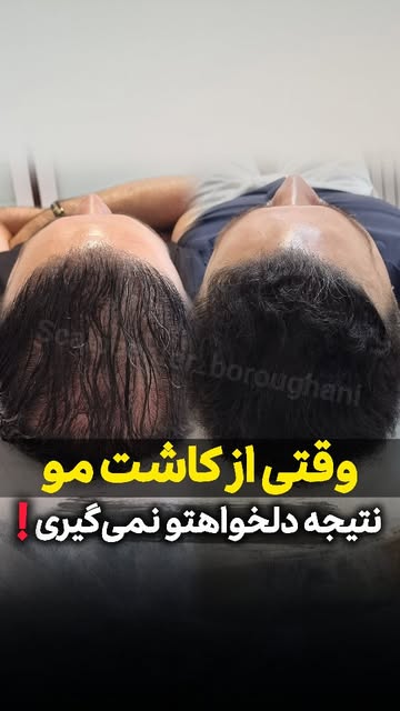 کاشت مو یا میکرواسکالپ؟! وقتی از کاشت مو نتیجه نمی‌گیری یا تجربه کاشت مو ناموفق داشتی! تنها روش موثر