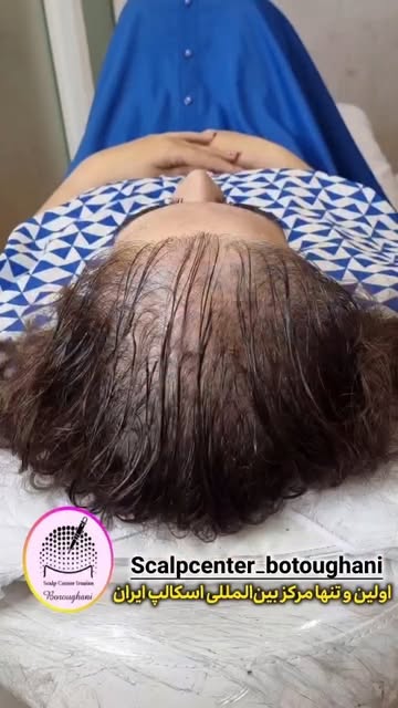 دیگ با میکرواسکالپ نگران کم‌پشتی موهات نباش🥰
مشاوره و رزرو ن بت با ارسال عدد *۹*
و یا دایرکت بدهید
