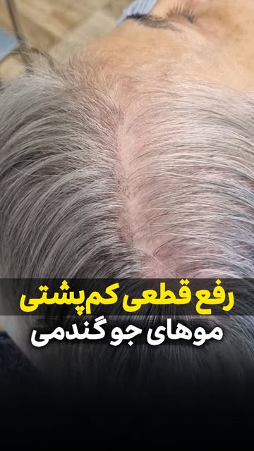 میدونستی که میکرواسکالپ برای همه نوع رنگ مو مناسب؟! رفع کم‌پشتی موها با میکرواسکالپ برای هر رنگ پوست