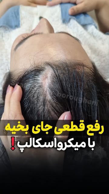هیچکی بت نگفته فقط با یک روش میشه جای اسکارها یا بخیه‌های لیفت شقیقه‌ها، جراحی و اسکار بجای مانده از