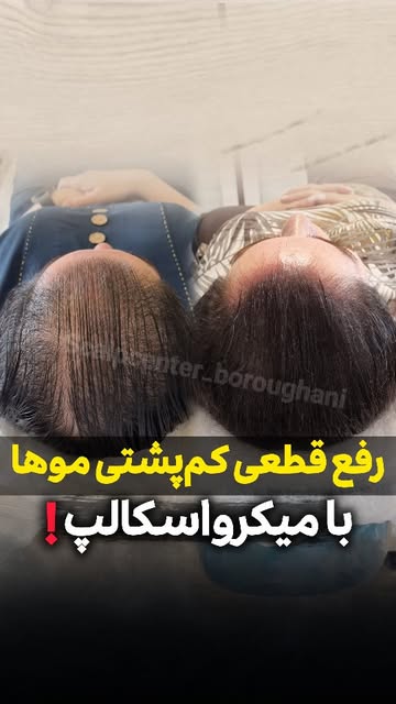 هیچکی بت نگفته که فقط با میکرواسکالپ یک ماهه موهات پرپشت‌تر میشن!!❌️
✅️برای اطلاع از شرایط و مشاوره 