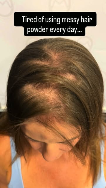 She was DONE with the hair powder. 🙅‍♀️

Every day meant using topical powder to disguise the areas