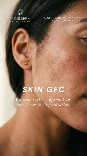 Acne scars and pigmentation can stay long after active acne is gone. ✨

Skin GFC offers a regenerati