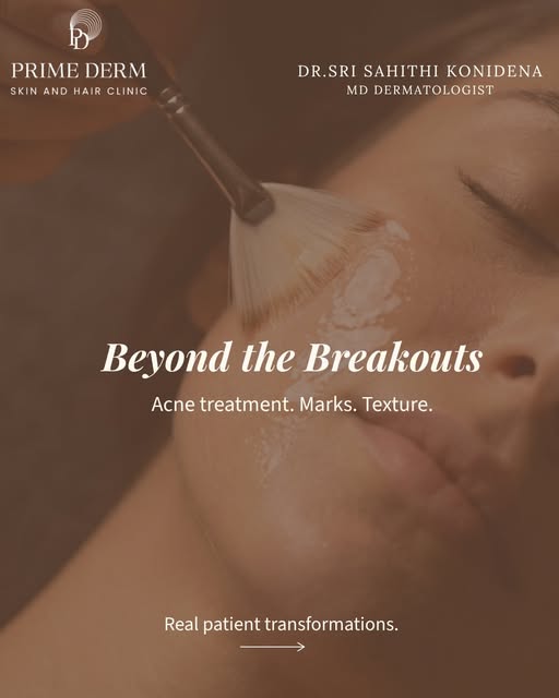 Acne is more than just a breakout.
It can leave behind marks, uneven tone, changes in texture and, i