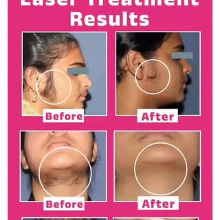 Laser Treatment Results...
Dr. Swapnil Shah Skin And Laser Clinic
Manik Chowk, Solapur - 9923956780
