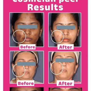 Taking care of your skin is more important than covering it up!
.
.
#drswapnilshahclinic #skincarepr