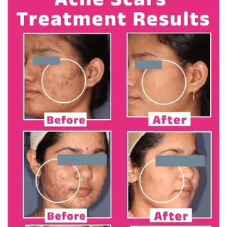 Acne Scars Treatment Results !
.
.
#drswapnilshahclinic #skindoctorindia #skincareproduct #smoothski