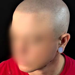 The next opponent is you 🪞🎭

Are you ready to face yourself?

Scalp Micro pigmentation is a techni