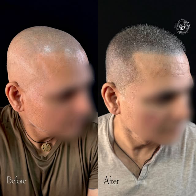 🧑‍🦲 Results of Scalp Micropigmentation ➡️

💬Comment SMP for free mock up and consultation 

Do yo