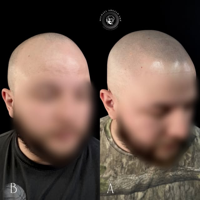 🔥 BEFORE & AFTER SMP ➡️ 1 MONTH HEALED

A complete Scalp Micropigmentation transformation for a cli