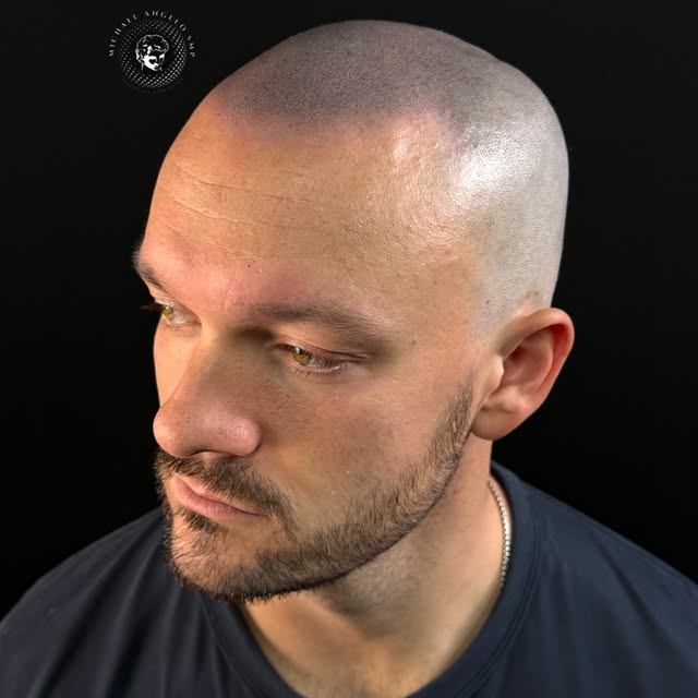🔥 HE’S BACK.

Before & After Scalp Micropigmentation | SMP

Meet my client, who came in with a rece