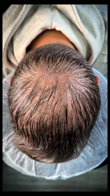 ✅THINNING CROWN FIX | SMP DENSITY

BEFORE & AFTER

My client had a previous hair transplant but stil